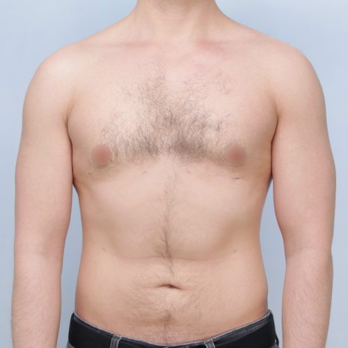 1B-61474_Liposukcja-brzucha_en-face_2024-02-26_174323-v2-aspect-ratio-500-500