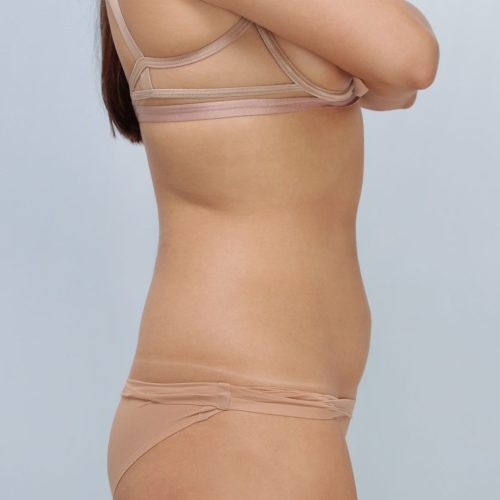 Ferenc-liposukcja-56305-1B-aspect-ratio-500-500