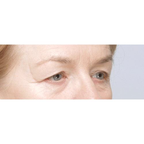 Ferenc-powieki-sameoczy-63608-2A-aspect-ratio-500-500