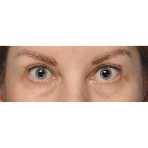 Michal10A-powieki-gorne-i-dolne-aspect-ratio-500-500