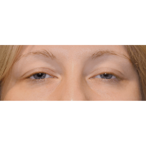 Michal1A-powieki-dolne-aspect-ratio-500-500