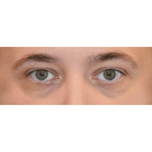 Michal2A-powieki-dolne-aspect-ratio-500-500