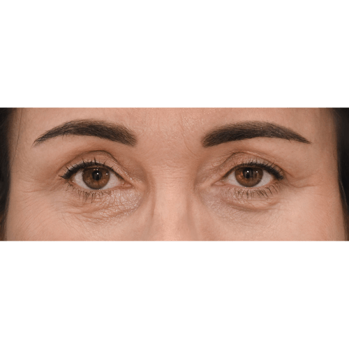 Michal9A-powieki-gorne-i-dolne-aspect-ratio-500-500