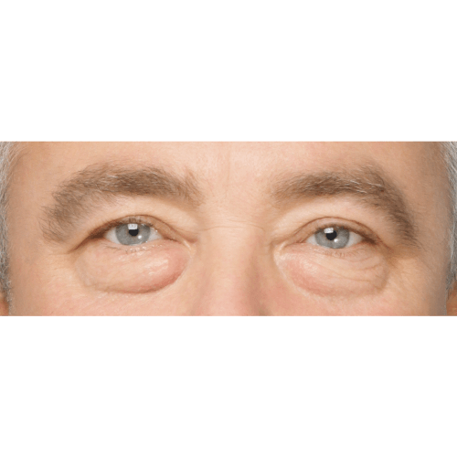 Miszczyk-powieki-dolne-1A-aspect-ratio-500-500