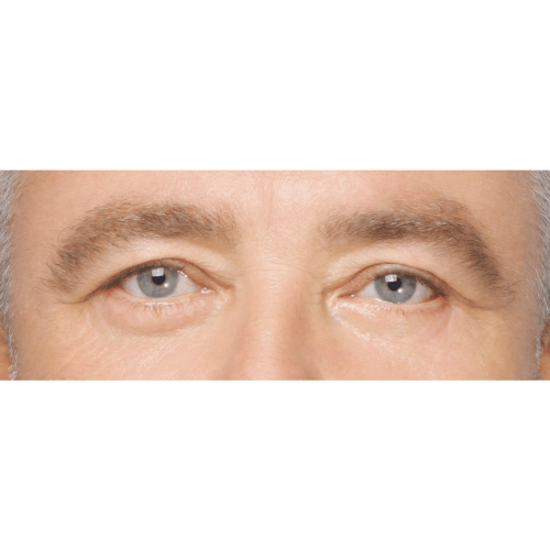 Miszczyk-powieki-dolne-1B-aspect-ratio-500-500