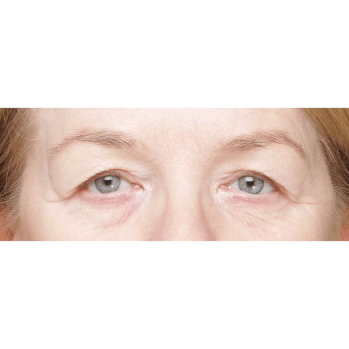 Ferenc-powieki-sameoczy-63608-3A-aspect-ratio-500-500