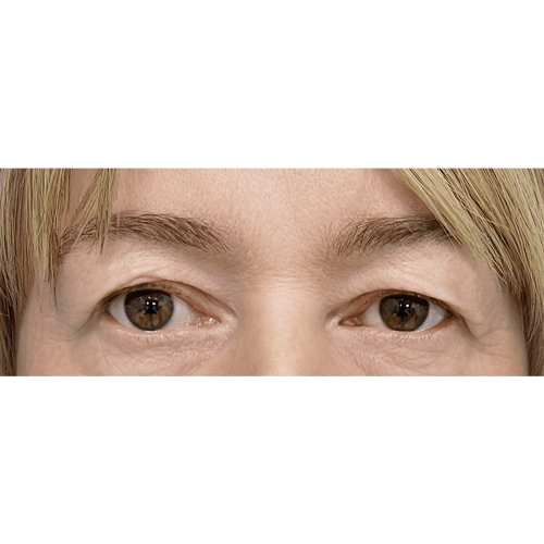 Miszczyk-brwi-powieki-1A-IMG-5632-aspect-ratio-500-500