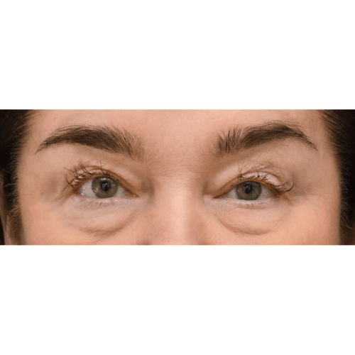 Michal8A-powieki-gorne-dolne-brwi-1-aspect-ratio-500-500