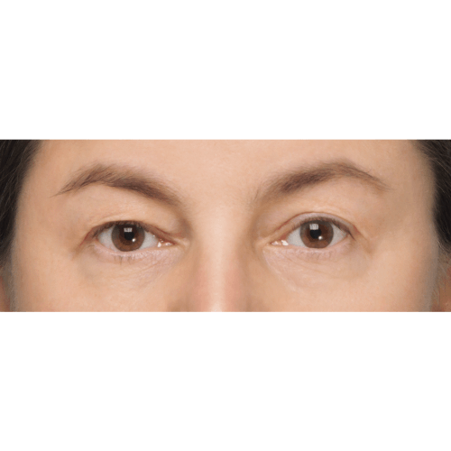 Miszczyk-powieki-gorne-11A-aspect-ratio-500-500