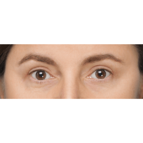 Miszczyk-powieki-gorne-11B-aspect-ratio-500-500