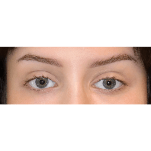 miszczyk-lift-brwi-8B-aspect-ratio-500-500