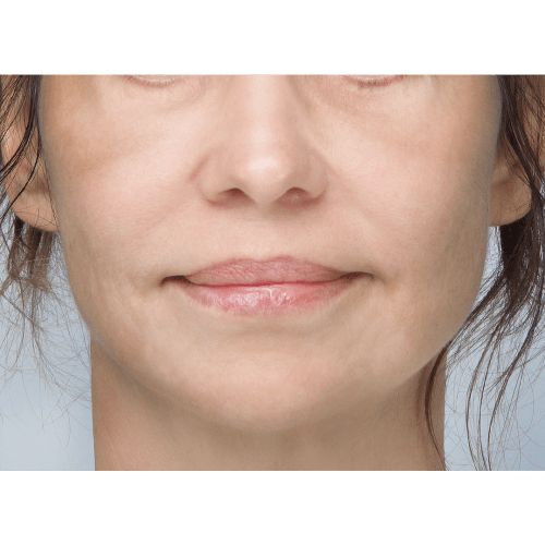 miszczyk-policzek-49117-1A-aspect-ratio-500-500