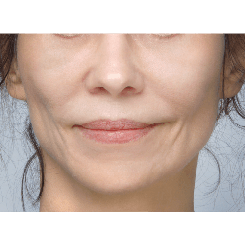 miszczyk-policzek-49117-1B-aspect-ratio-500-500