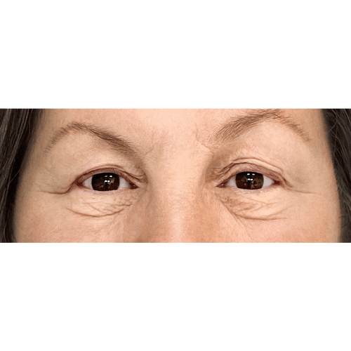 miszczyk-powieki-gorne-12a-1-aspect-ratio-500-500