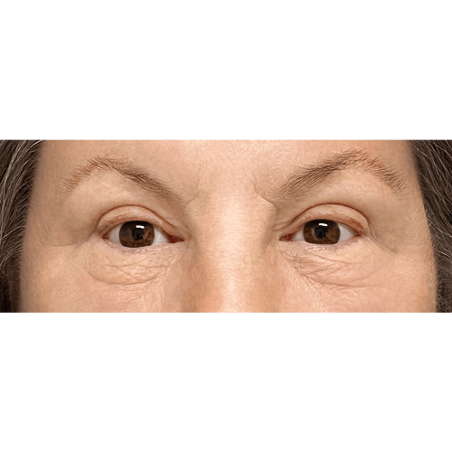 miszczyk-powieki-gorne-12b-aspect-ratio-500-500