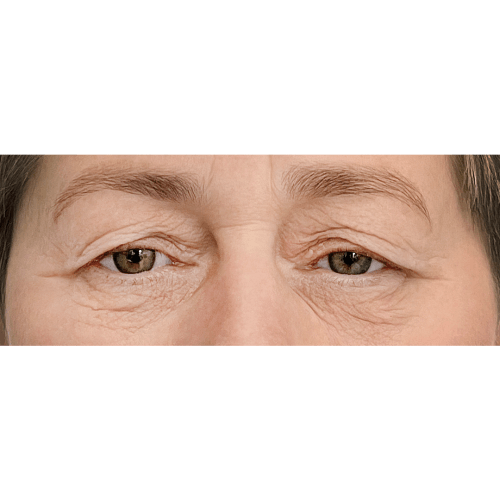 miszczyk-powieki-gorne-13a-aspect-ratio-500-500