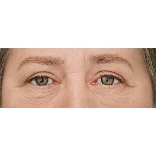 miszczyk-powieki-gorne-13b-aspect-ratio-500-500