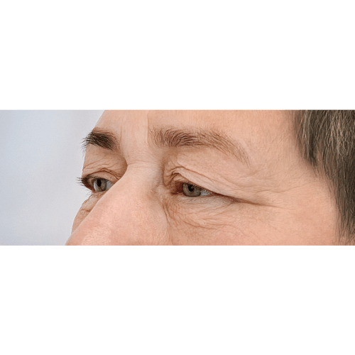 miszczyk-powieki-gorne-13c-aspect-ratio-500-500