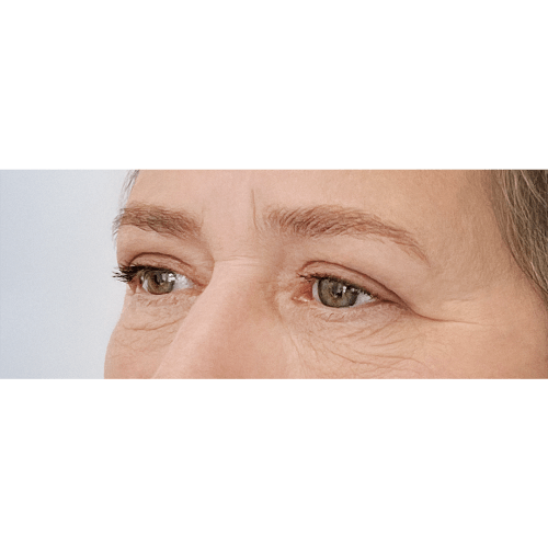 miszczyk-powieki-gorne-13d-aspect-ratio-500-500