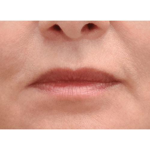 michal-lip-lift-1b-aspect-ratio-500-500