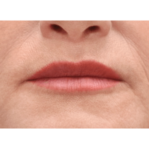 michal-lip-lift-2b-aspect-ratio-500-500