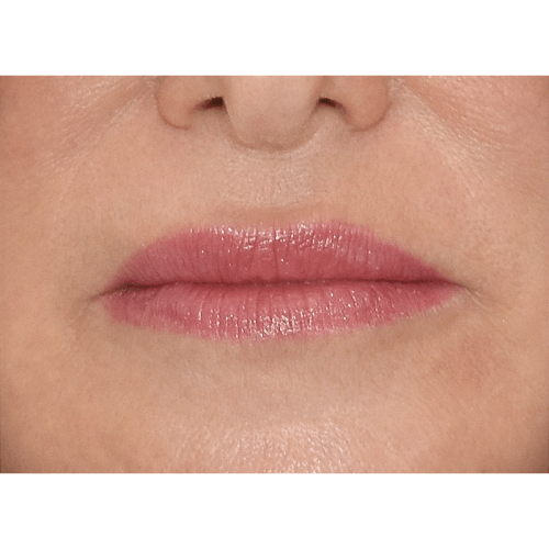 michal-lip-lift-3a-aspect-ratio-500-500