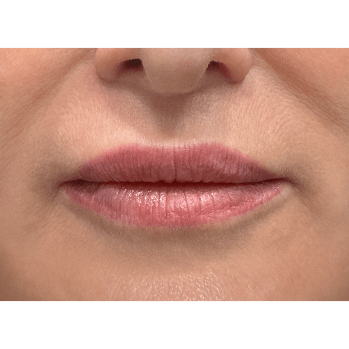 michal-lip-lift-3b-aspect-ratio-500-500