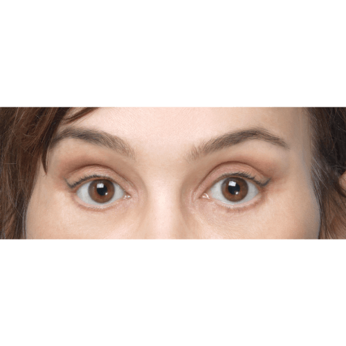 miszczyk-lift-endo-49117-nowyb-aspect-ratio-500-500