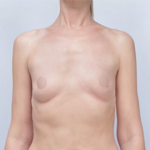 ferenc-implanty-68120-6a-1-aspect-ratio-500-500