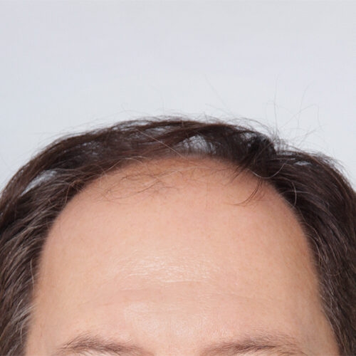 miszczyk-przeszcze-wlosow-29a-aspect-ratio-500-500