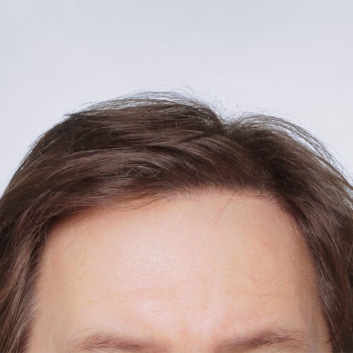 miszczyk-przeszcze-wlosow-29b-aspect-ratio-500-500