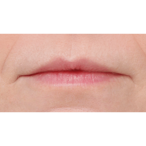 miszczyk-lip-lift-2c-aspect-ratio-500-500