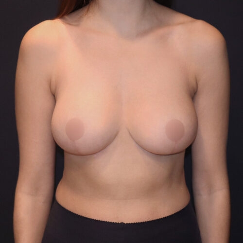 daria-piersi-redukcja-id62442-34b-aspect-ratio-500-500