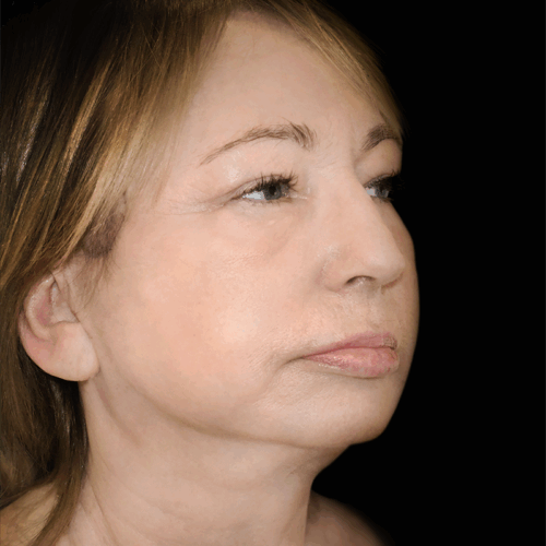 dpfl2d-aspect-ratio-500-500