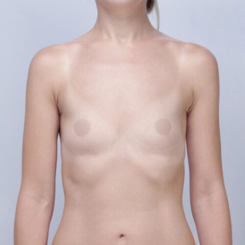 kulesza-implanty-id68388-8a-aspect-ratio-500-500