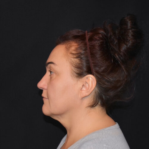 lift-michal-15e-aspect-ratio-500-500