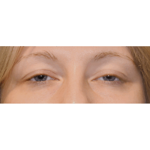 michal1a-powieki-dolne-aspect-ratio-500-500