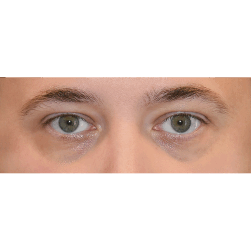 michal2a-powieki-dolne-aspect-ratio-500-500