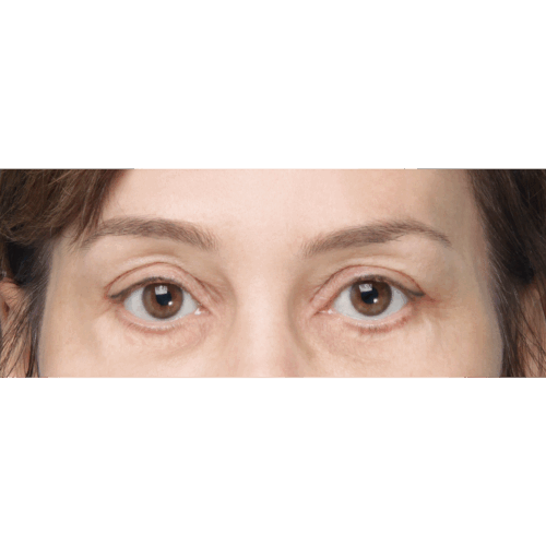 miszczyk-lift-endo-49117-12a-aspect-ratio-500-500