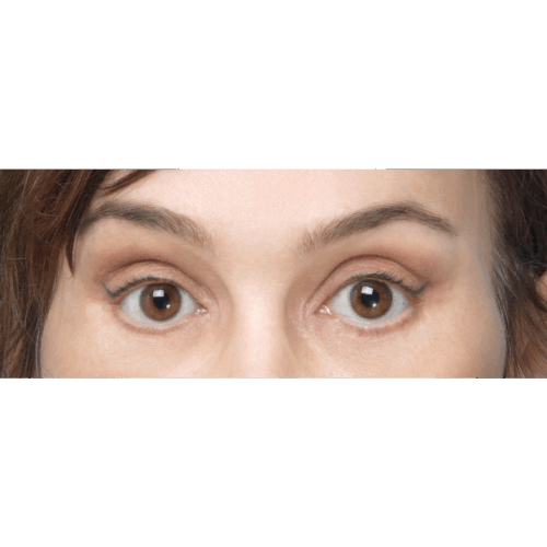 miszczyk-lift-endo-49117-12b-aspect-ratio-500-500