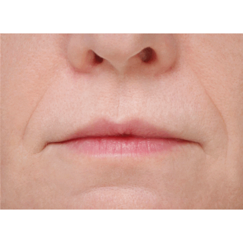 miszczyk-lip-lift-2a-aspect-ratio-500-500