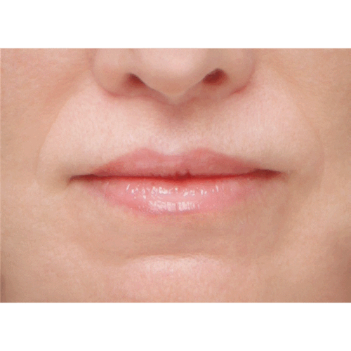 miszczyk-lip-lift-2b-aspect-ratio-500-500
