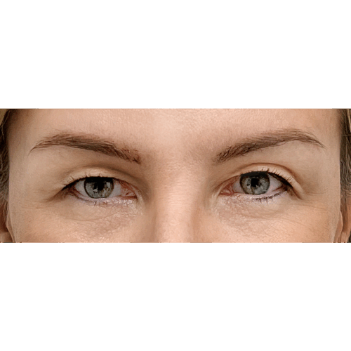 miszczyk-powieki-7a-090524-aspect-ratio-500-500