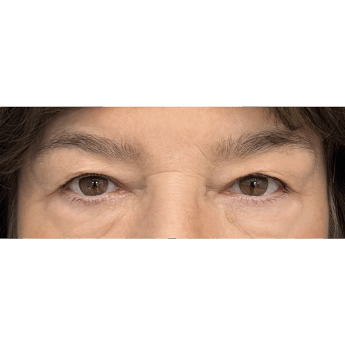 miszczyk-powieki-9a-aspect-ratio-500-500