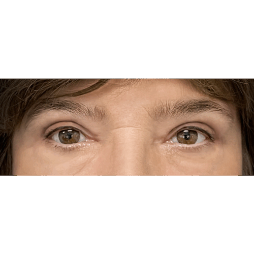 miszczyk-powieki-9b-aspect-ratio-500-500