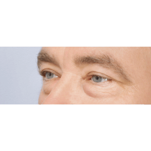 miszczyk-powieki-dolne-1c-aspect-ratio-500-500