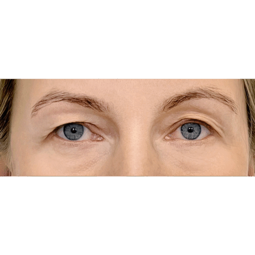 miszczyk-powieki-gorne-10a-aspect-ratio-500-500