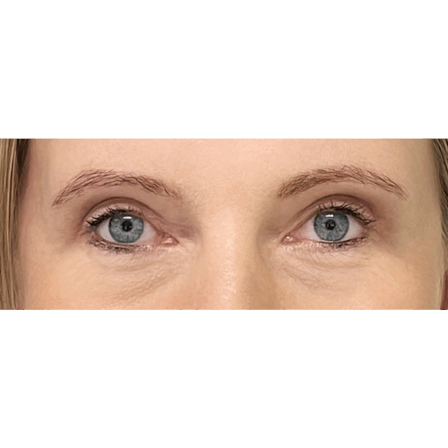 miszczyk-powieki-gorne-10b-aspect-ratio-500-500