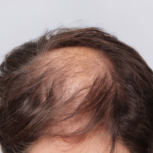 miszczyk-przeszcze-wlosow-29c-aspect-ratio-500-500