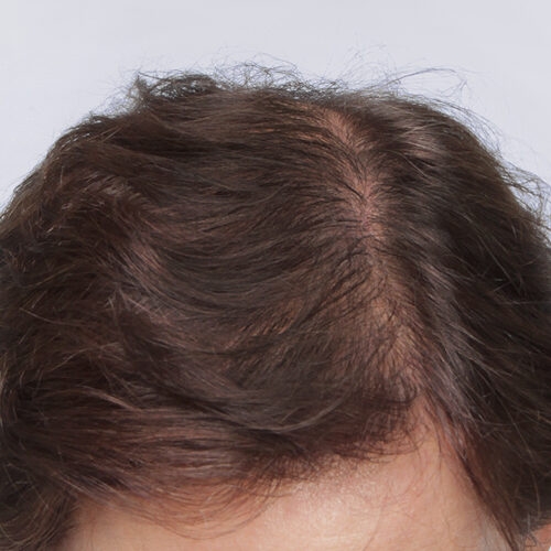 miszczyk-przeszcze-wlosow-29d-aspect-ratio-500-500